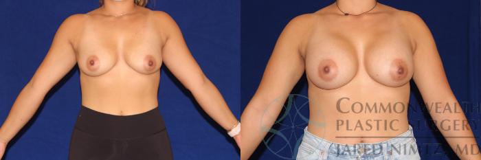 Before & After Breast Augmentation Case 102 Front View in Lexington & London, KY