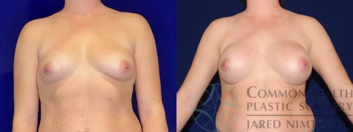 Before & After Breast Augmentation Case 105 Front View in Lexington & London, KY