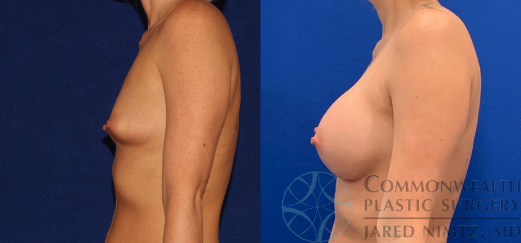 Before & After Breast Augmentation Case 137 Left Side View in Lexington & Lousiville, KY