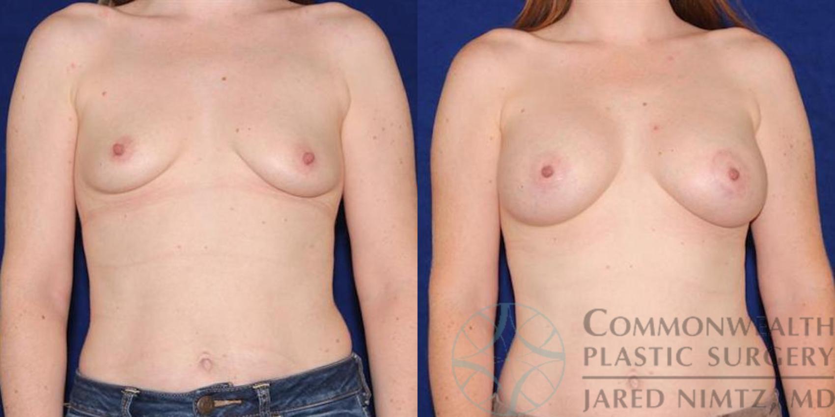 Before & After Breast Augmentation Case 46 View #1 View in Lexington & London, KY