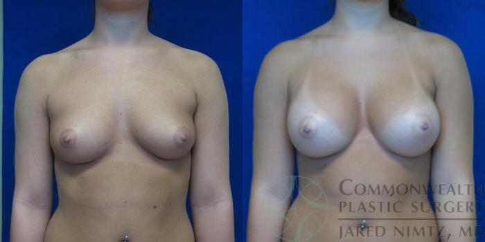 Before & After Breast Augmentation Case 48 View #1 View in Lexington & London, KY