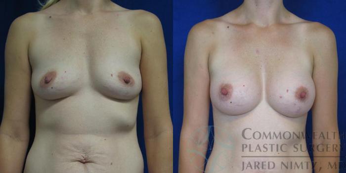 Before & After Breast Augmentation Case 49 View #1 View in Lexington & London, KY