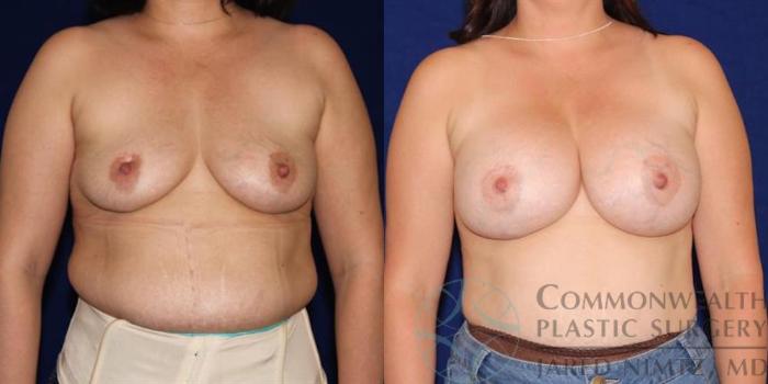 Before & After Breast Augmentation Case 50 View #1 View in Lexington & London, KY