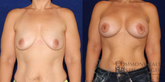 Before & After Breast Augmentation Case 77 View #1 View in Lexington & London, KY