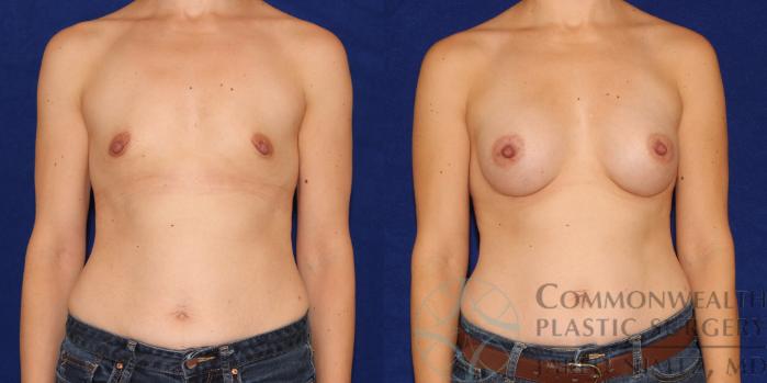 Before & After Breast Augmentation Case 86 View #1 View in Lexington & London, KY