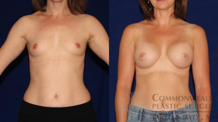Before & After Breast Augmentation Case 91 Front View in Lexington & London, KY