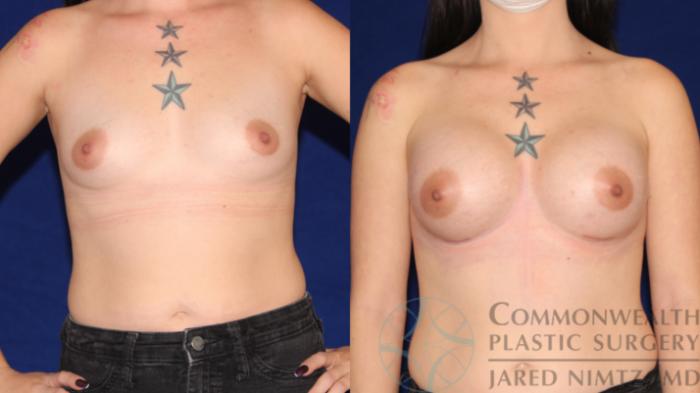 Before & After Breast Augmentation Case 99 Front View in Lexington & London, KY