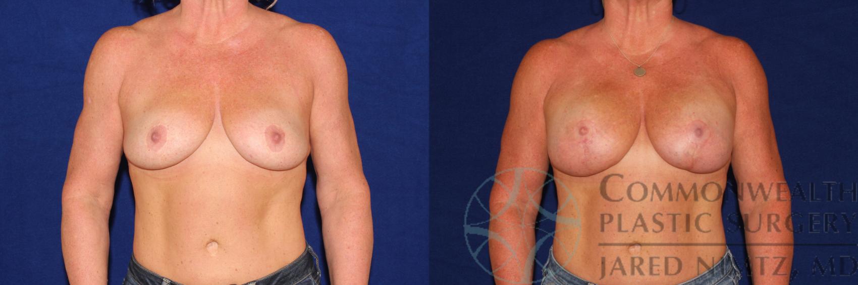 Before & After Breast Lift Case 110 Front View in Lexington & London, KY