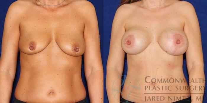 Before & After Breast Augmentation Case 55 View #1 View in Lexington & London, KY