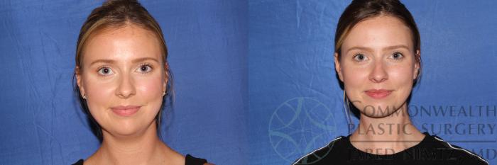 Before & After Neck Liposuction Case 132 Front View in Lexington & Lousiville, KY
