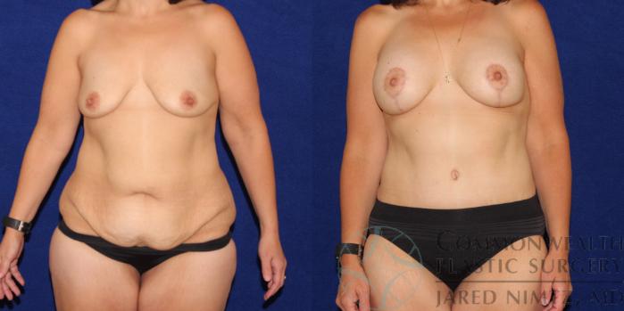 Before & After Breast Lift Case 79 View #1 View in Lexington & London, KY