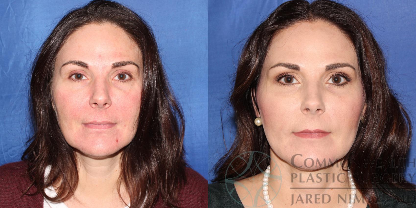 Before & After Neck Lift Case 89 View #1 View in Lexington & London, KY