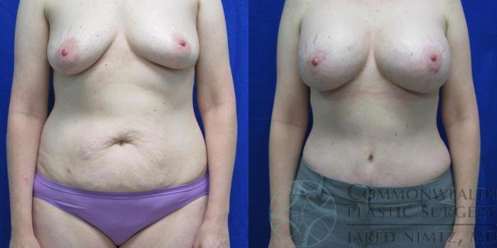 Before & After Tummy Tuck Case 38 View #1 View in Lexington & London, KY