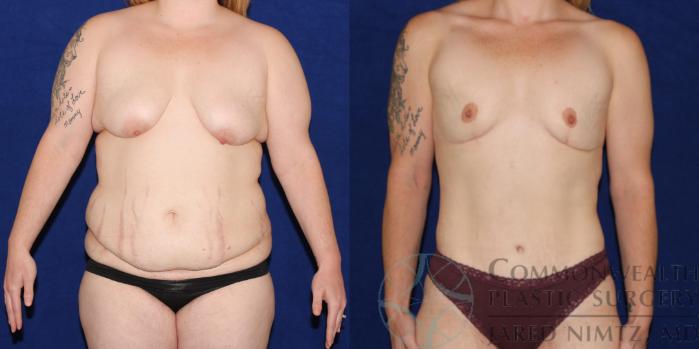 Before & After Breast Lift Case 83 View #1 View in Lexington & London, KY