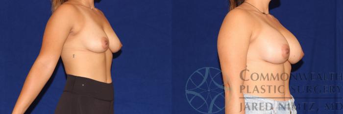 Before & After Breast Augmentation Case 102 Right Oblique View in Lexington & London, KY