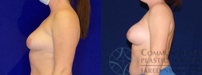 Before & After Breast Augmentation Case 105 Left Side View in Lexington & London, KY