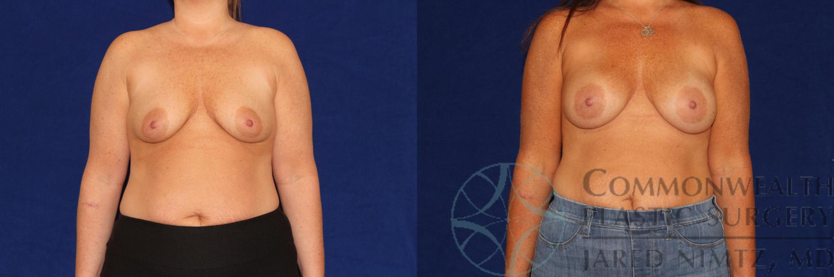 Before & After Breast Augmentation Case 114 Front View in Lexington & London, KY