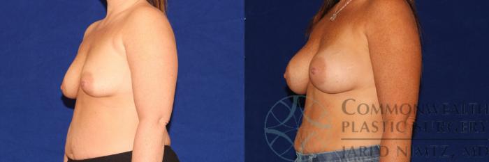 Before & After Breast Augmentation Case 114 Left Oblique View in Lexington & London, KY