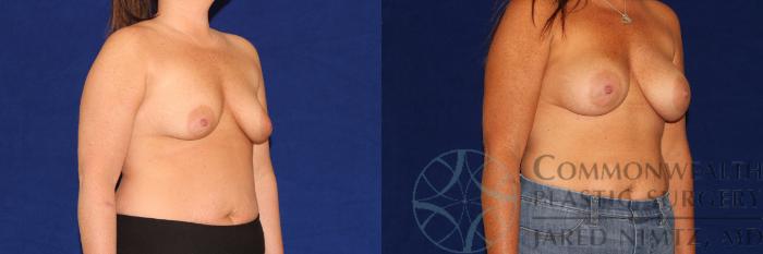 Before & After Breast Augmentation Case 114 Right Oblique View in Lexington & London, KY