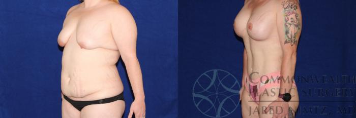 Before & After Breast Augmentation Case 115 Left Oblique View in Lexington & London, KY