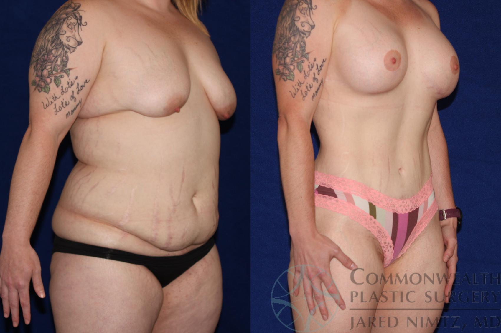 Before & After Breast Augmentation Case 115 Right Oblique View in Lexington & London, KY