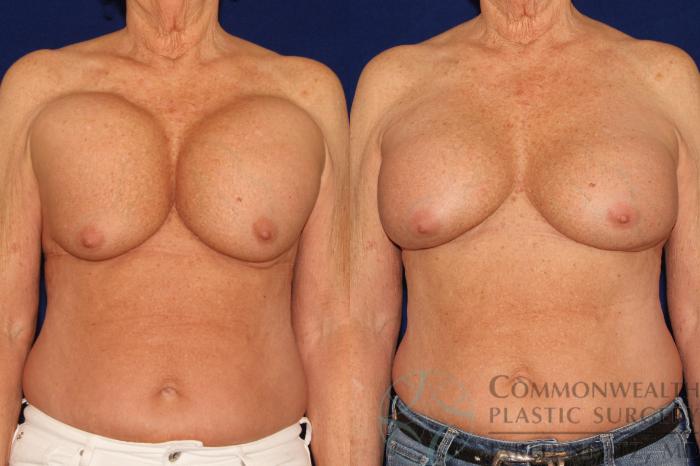 Before & After Breast Augmentation Case 128 Front View in Lexington & London, KY