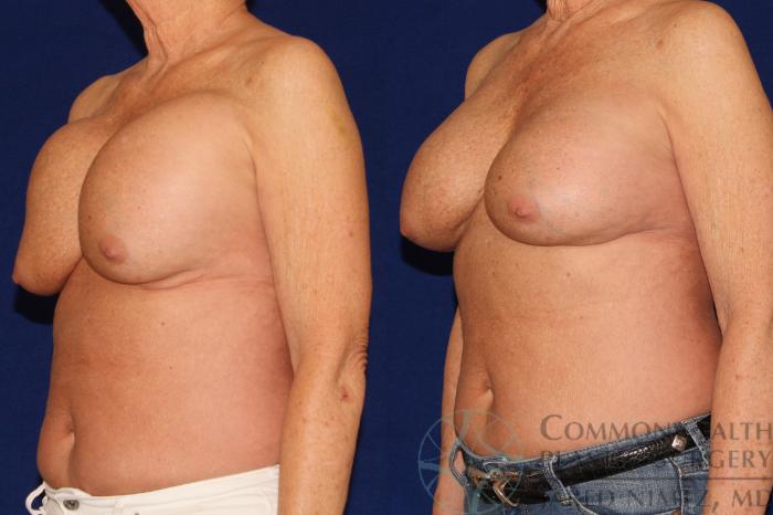 Before & After Breast Augmentation Case 128 Left Oblique View in Lexington & London, KY