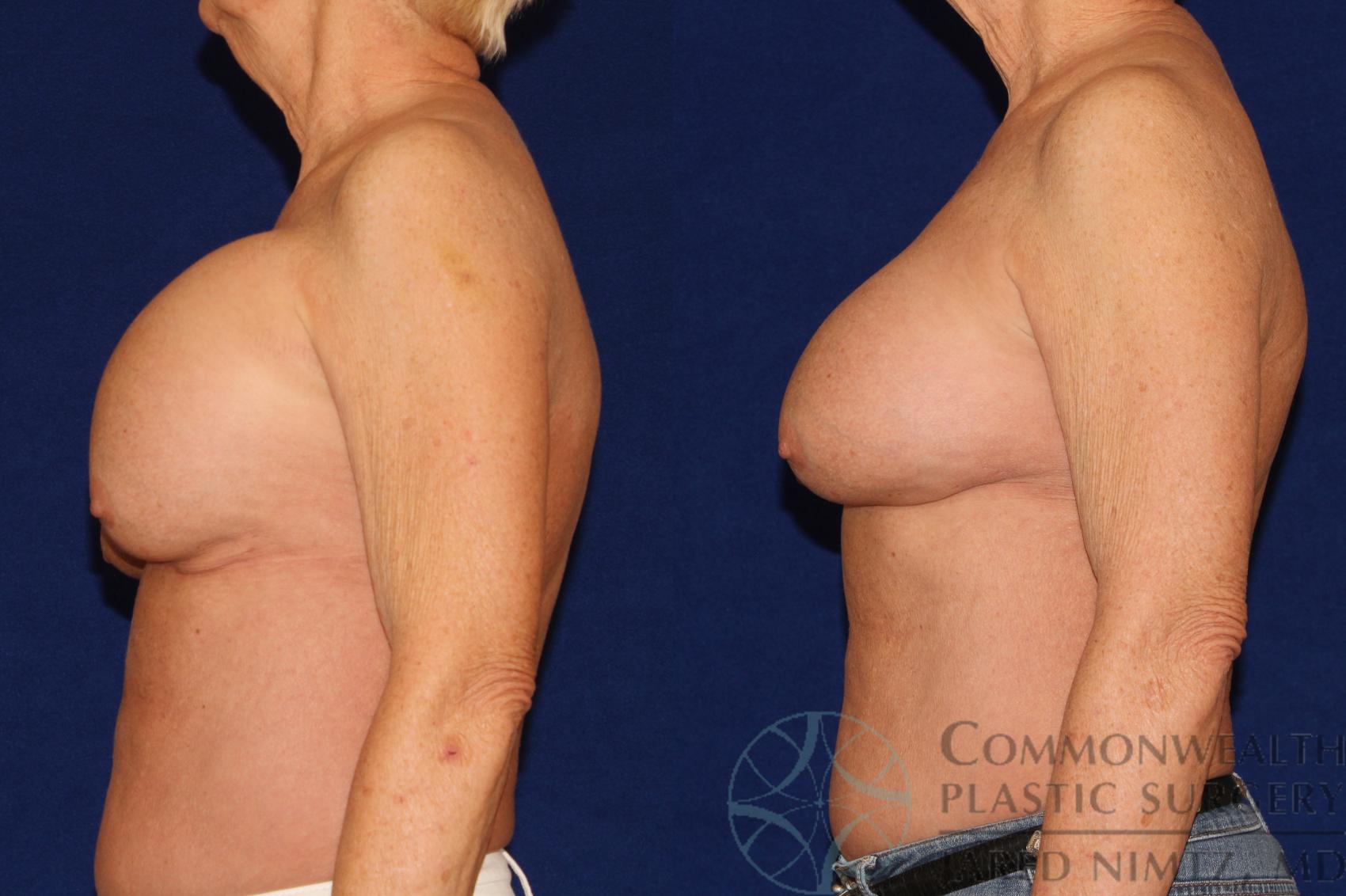 Before & After Breast Augmentation Case 128 Left Side View in Lexington & London, KY