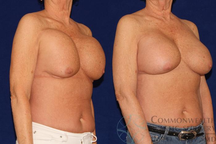 Before & After Breast Augmentation Case 128 Right Oblique View in Lexington & London, KY