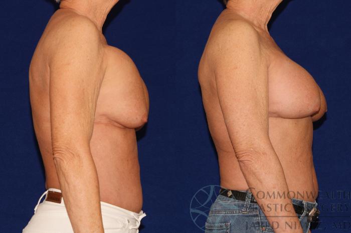 Before & After Breast Augmentation Case 128 Right Side View in Lexington & London, KY