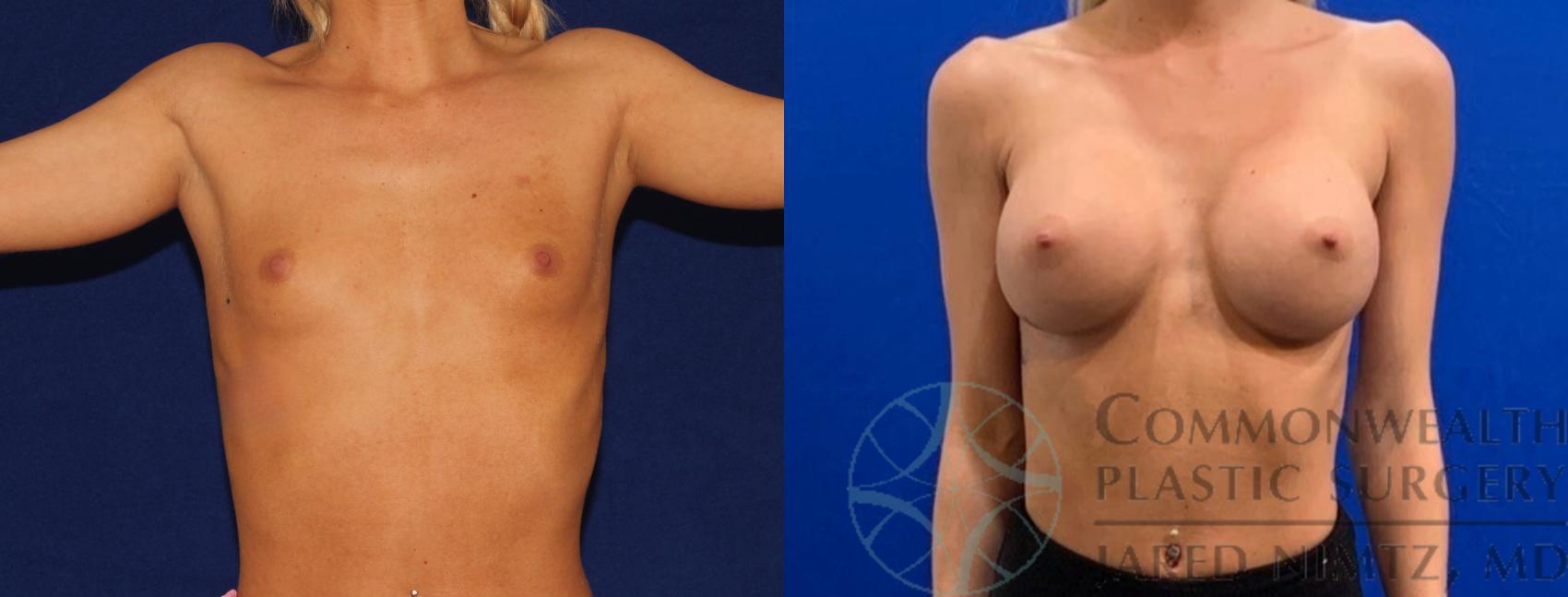 Before & After Breast Augmentation Case 133 Front View in Lexington & Lousiville, KY