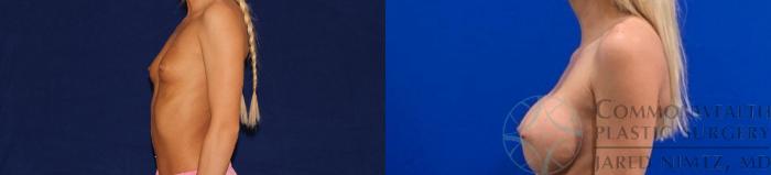 Before & After Breast Augmentation Case 133 Left Side View in Lexington & Lousiville, KY