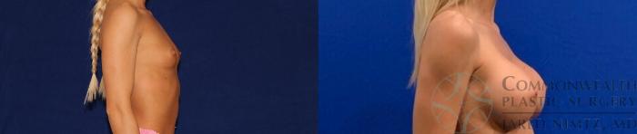 Before & After Breast Augmentation Case 133 Right Side View in Lexington & Lousiville, KY