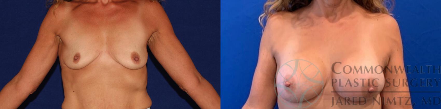 Before & After Breast Augmentation Case 134 Front View in Lexington & Lousiville, KY