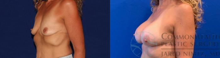 Before & After Breast Augmentation Case 134 Left Oblique View in Lexington & Lousiville, KY