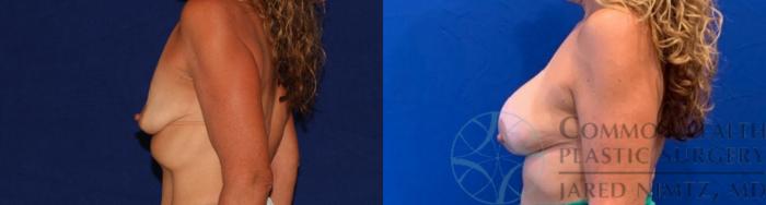 Before & After Breast Augmentation Case 134 Left Side View in Lexington & Lousiville, KY