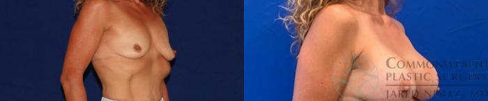 Before & After Breast Augmentation Case 134 Right Oblique View in Lexington & Lousiville, KY