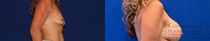 Before & After Breast Augmentation Case 134 Right Side View in Lexington & Lousiville, KY