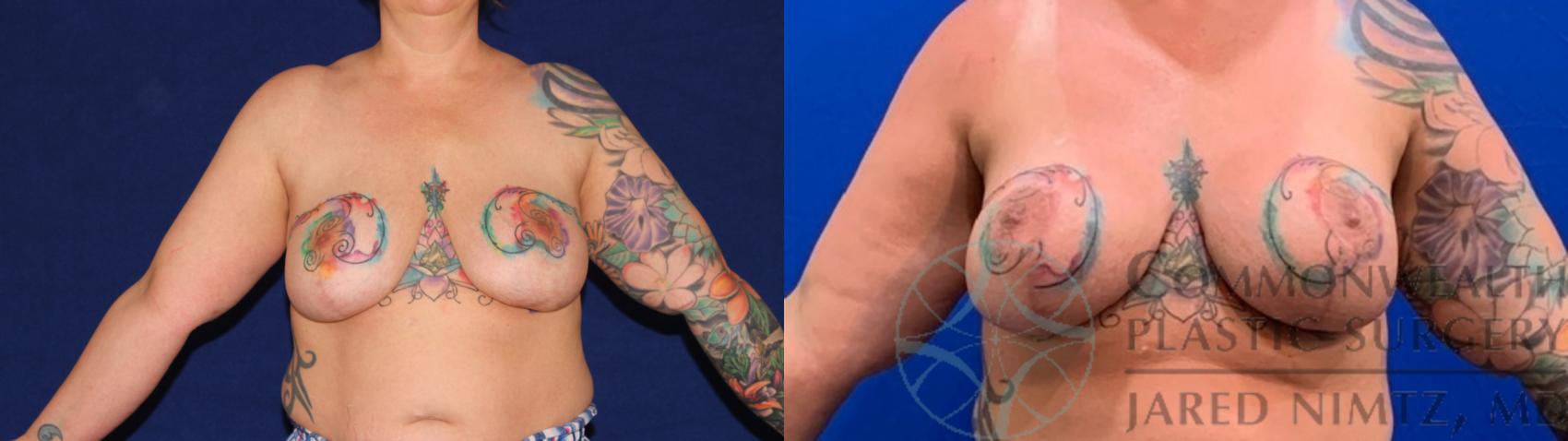 Before & After Breast Augmentation Case 136 Front View in Lexington & Lousiville, KY