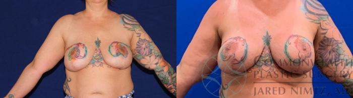 Before & After Breast Augmentation Case 136 Front View in Lexington & Lousiville, KY