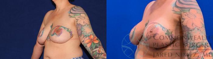 Before & After Breast Augmentation Case 136 Left Oblique View in Lexington & Lousiville, KY