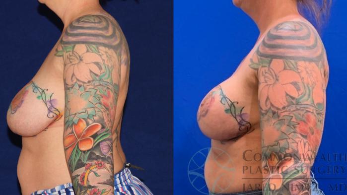 Before & After Breast Augmentation Case 136 Left Side View in Lexington & Lousiville, KY