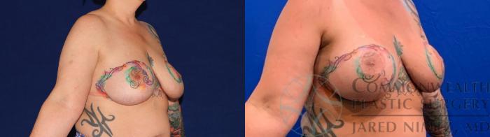 Before & After Breast Augmentation Case 136 Right Oblique View in Lexington & Lousiville, KY