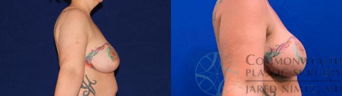 Before & After Breast Augmentation Case 136 Right Side View in Lexington & Lousiville, KY