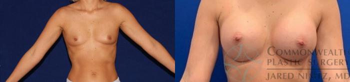 Before & After Breast Augmentation Case 137 Front View in Lexington & Lousiville, KY