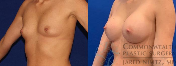 Before & After Breast Augmentation Case 137 Left Oblique View in Lexington & Lousiville, KY