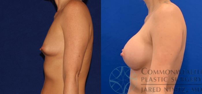 Before & After Breast Augmentation Case 137 Left Side View in Lexington & Lousiville, KY