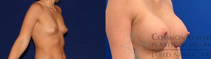 Before & After Breast Augmentation Case 137 Right Oblique View in Lexington & Lousiville, KY