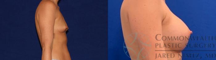 Before & After Breast Augmentation Case 137 Right Side View in Lexington & Lousiville, KY
