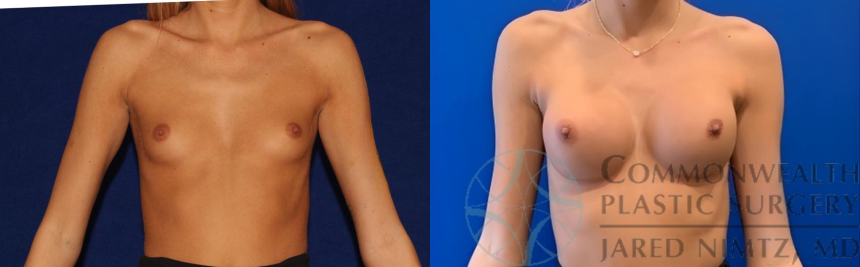 Before & After Breast Augmentation Case 140 Front View in Lexington & Lousiville, KY